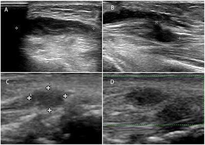 Traumatic neuromas of peripheral nerves: Diagnosis, management and future perspectives